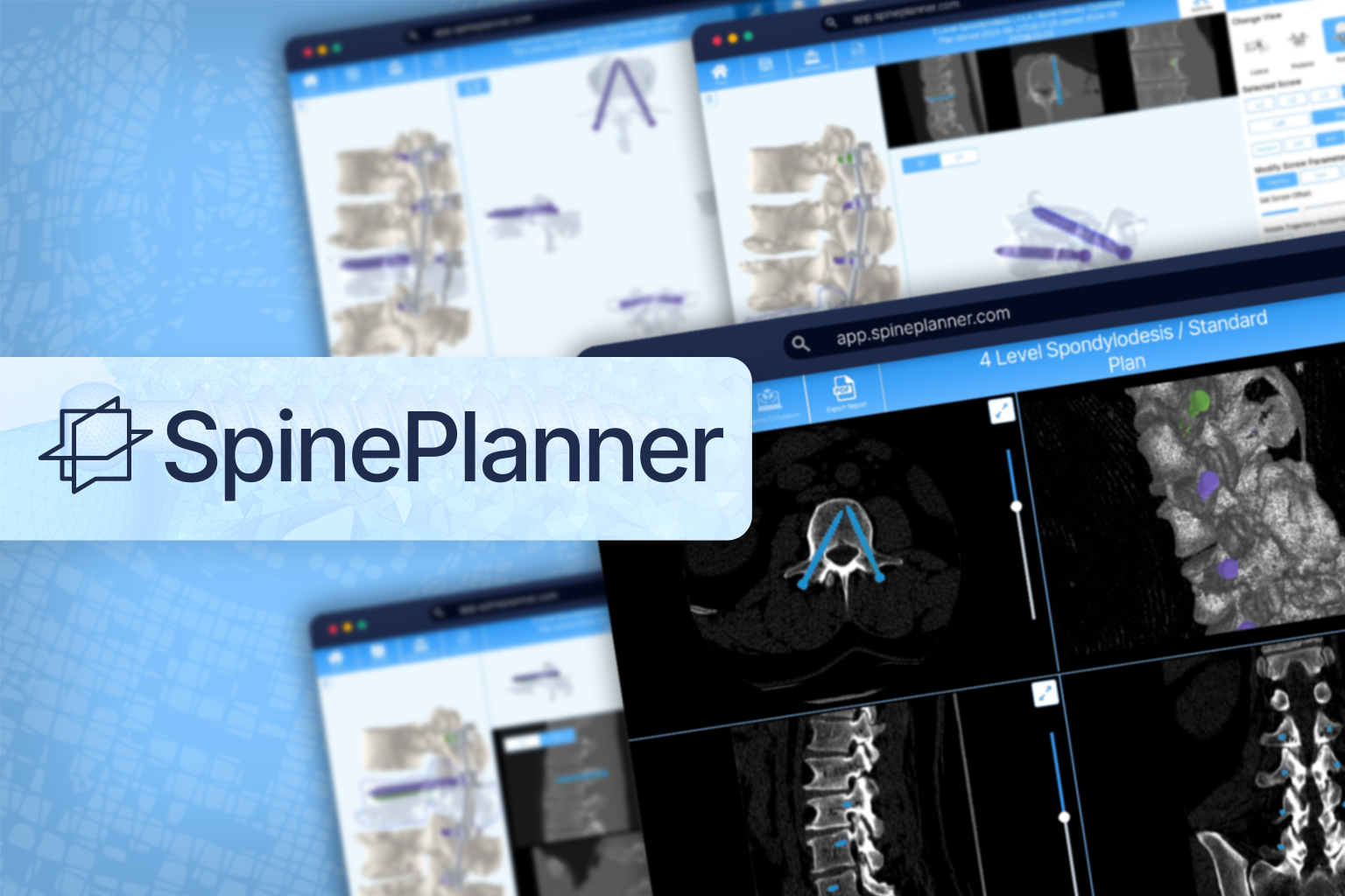 SpinePlanner - Medical Web Platform screenshot showing Advanced medical software for planning posterior lumbar spinal fusion surgeries with automated CT scan analysis and optimal instrumentation configuration developed with Unity for multiple platforms