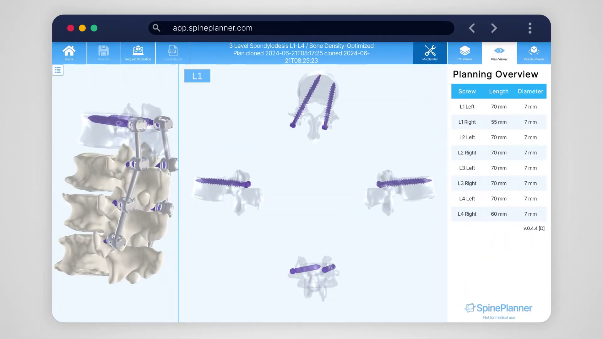 SpinePlanner instrumentation configuration with screw stability evaluation