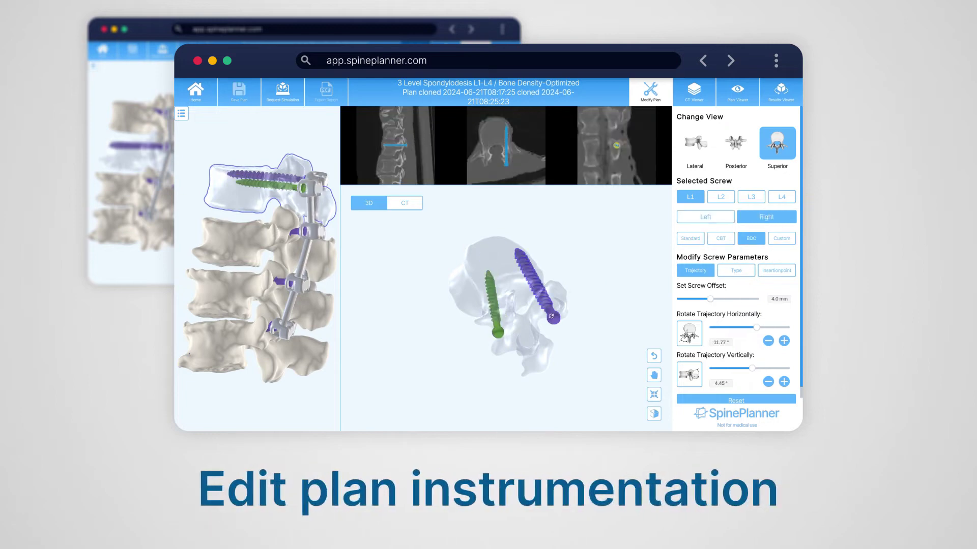 SpinePlanner interactive plan review and adjustment platform