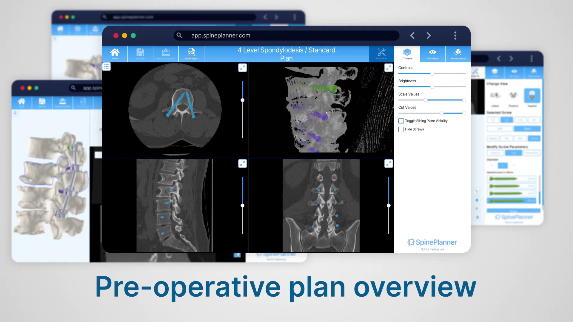 SpinePlanner surgical simulation report generation interface