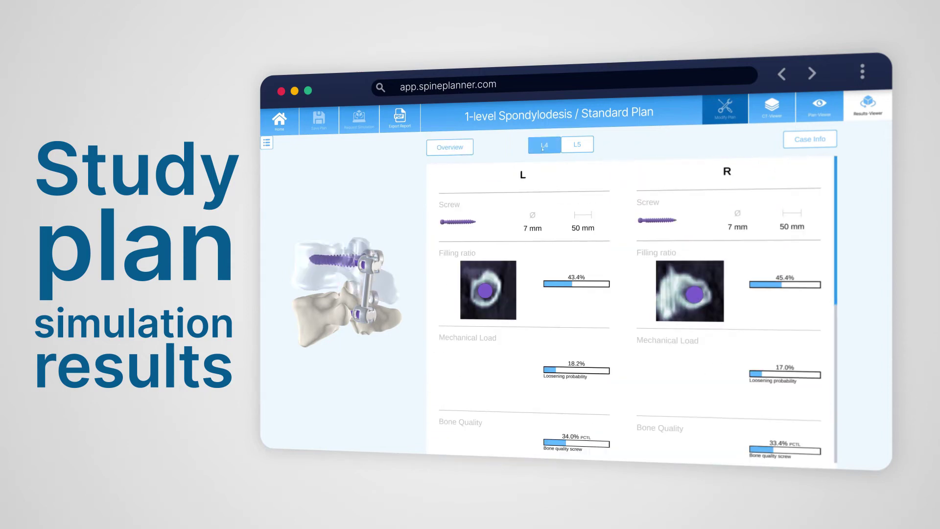 SpinePlanner medical visualization and surgical team communication tools